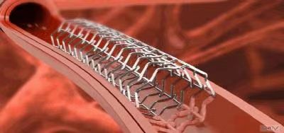 顯影環去毛刺處理工藝 顯影環去毛刺處理工藝